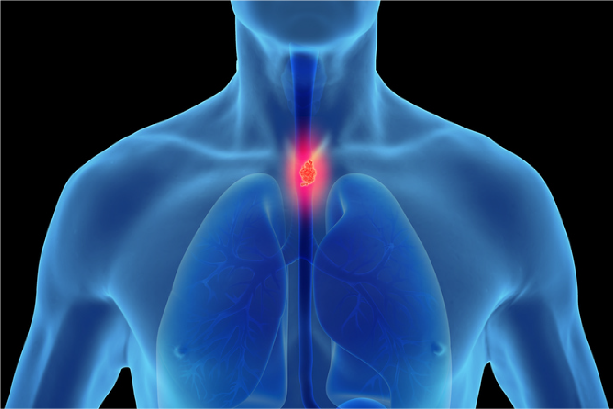 Esophageal Cancer