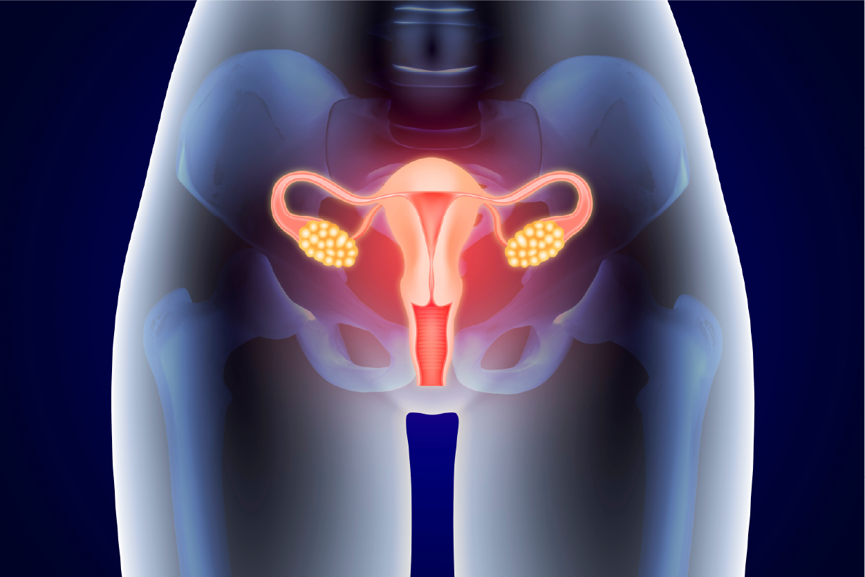 Gynecologic Cancer
