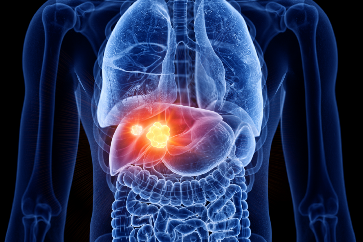Liver Cancer