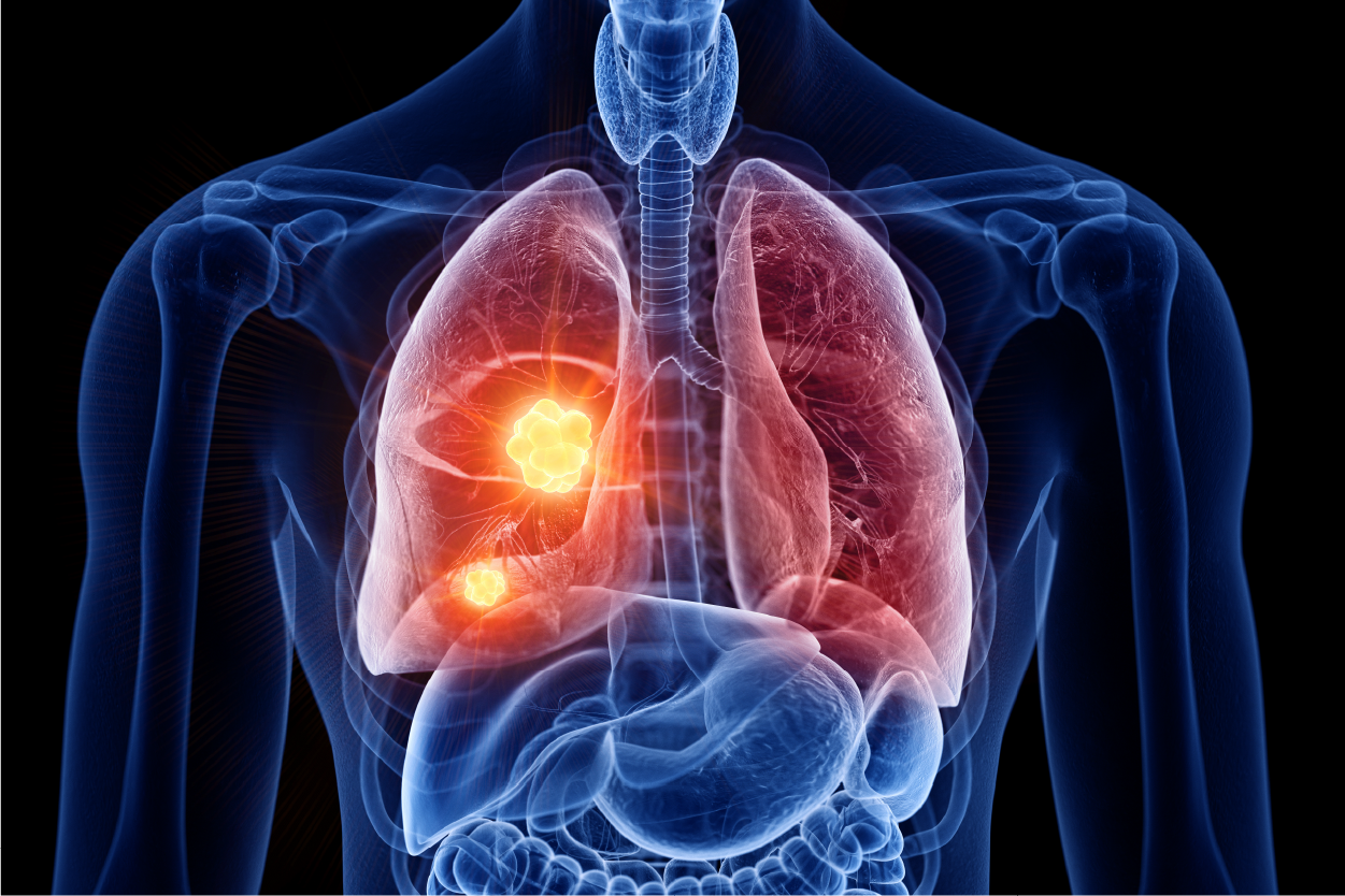 Lung Cancer