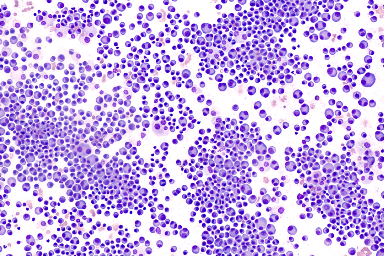 Myeloma