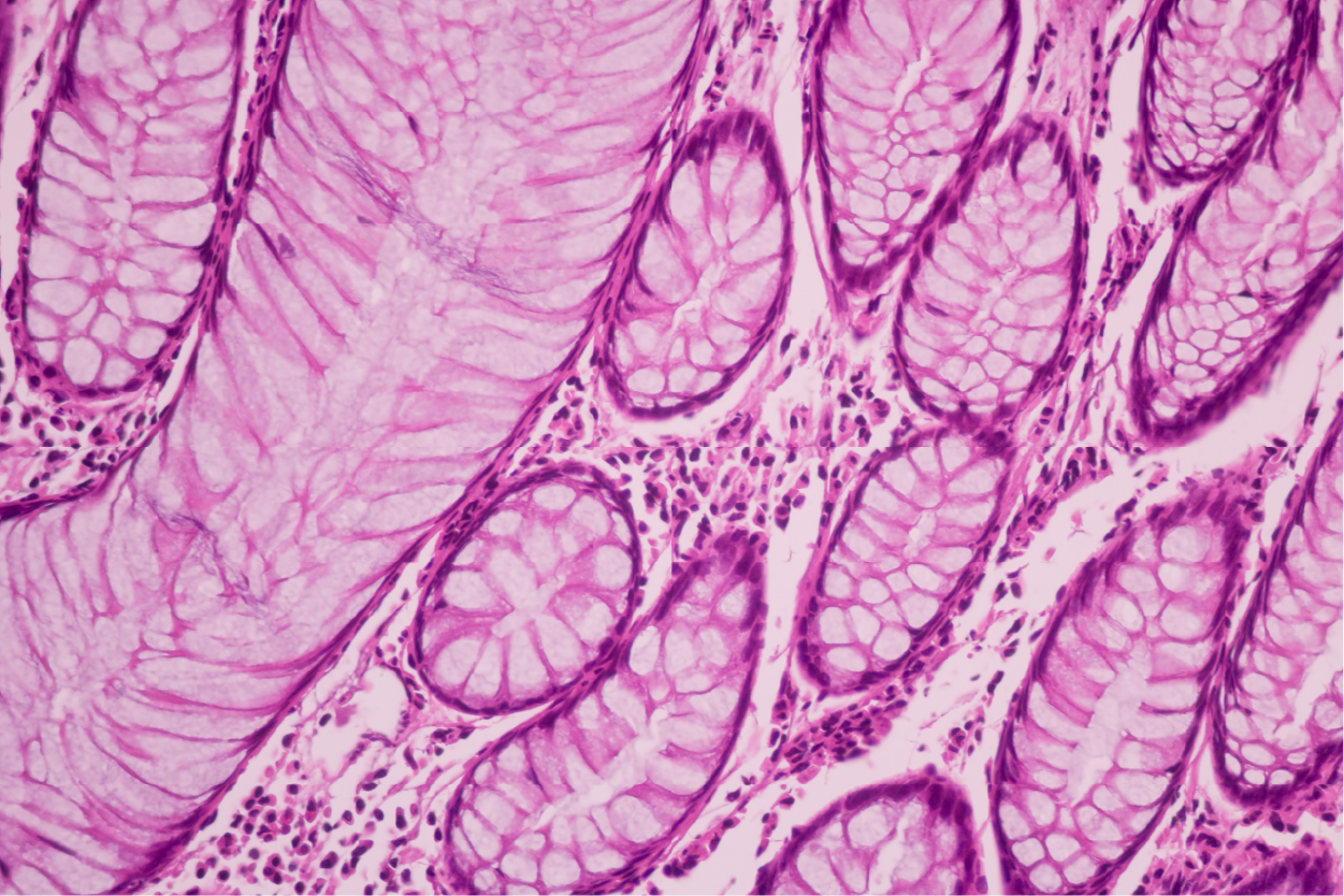 Skin Cancer