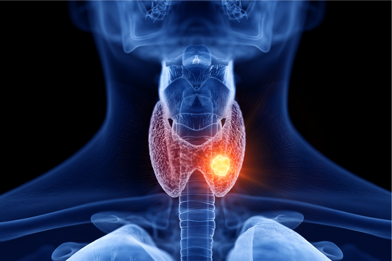 Thyroid Cancer